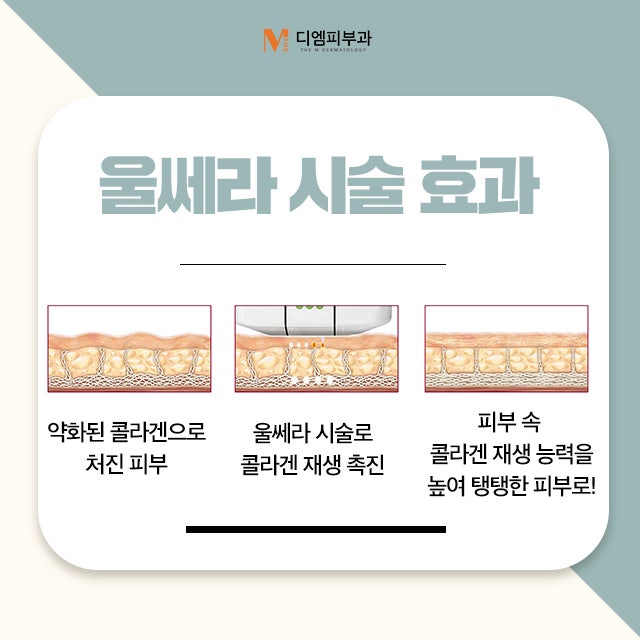 신사울쎄라잘하는피부과 리프팅과 탄력 개선과 주름을 한번에! 사진 4