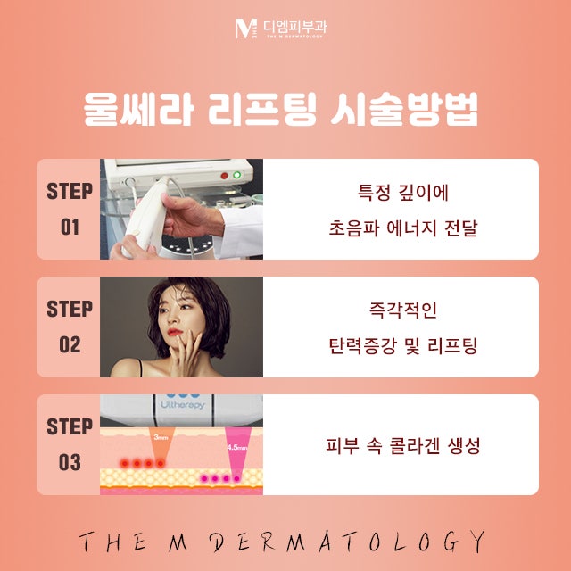 강남구청울쎄라의 강력한 리프팅 효과! 사진 4