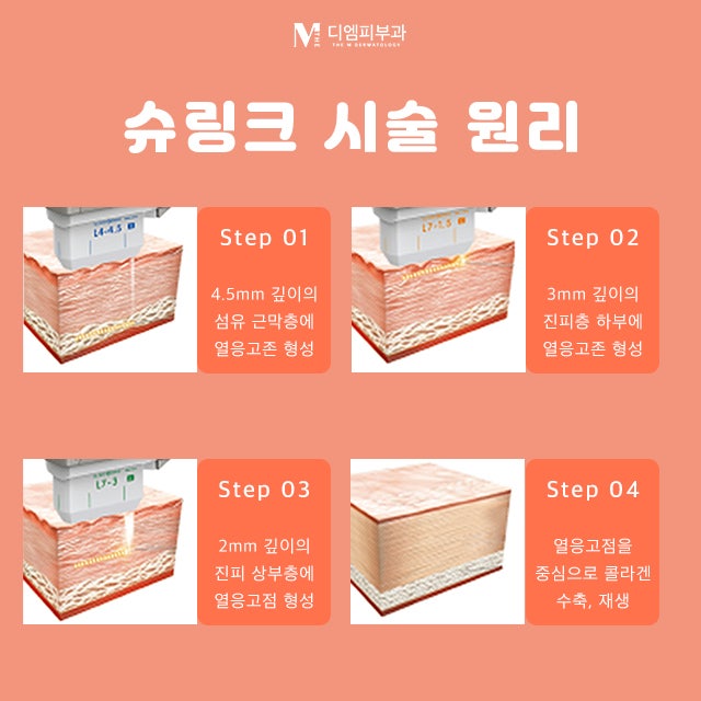 교대슈링크로 아름답게 되찾는 젊음 사진 5