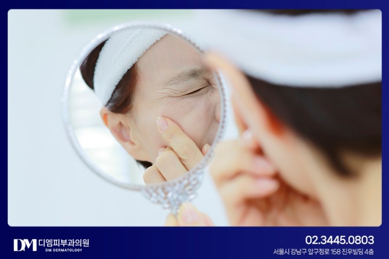 여드름 흉터 치료 :: 흉터 모양, 깊이에 따라 적절한 치료