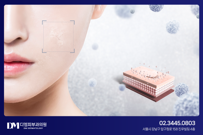 피부처짐, 잔주름이 고민이라면? 리쥬란힐러! 사진 3