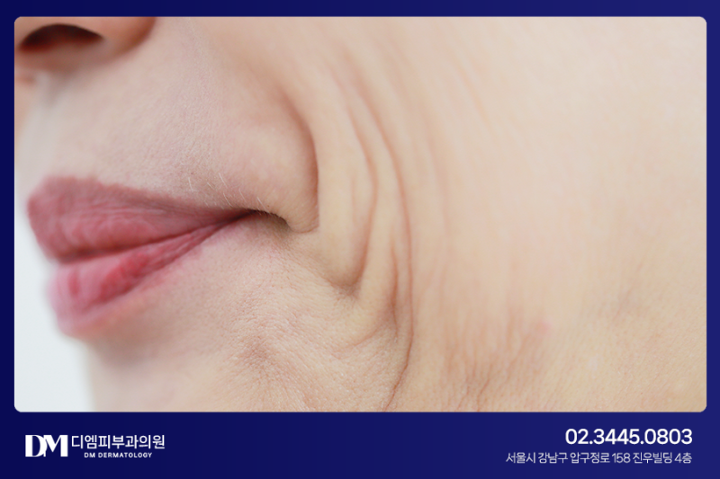 압구정실리프팅, 내게 맞는 방법으로 시술해야