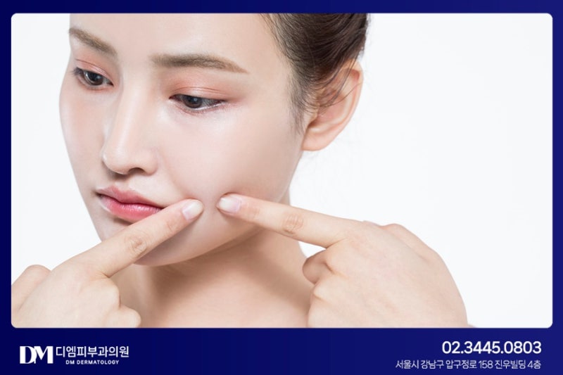 고온다습한 여름철! 여드름 관리는 어떻게 하나요 사진 5