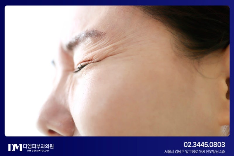 미간 주름 보톡스를 통해 개선하자 사진 5