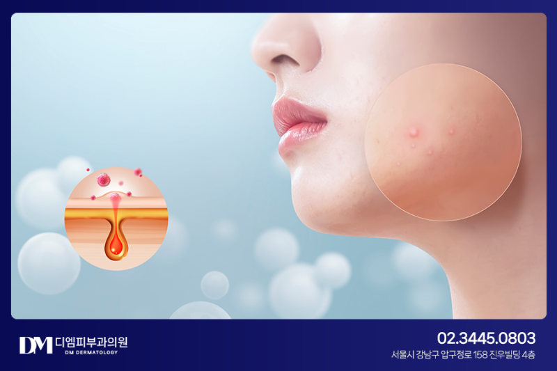 재발 쉬운 여드름, 흉터가 고민이라면? 사진 4