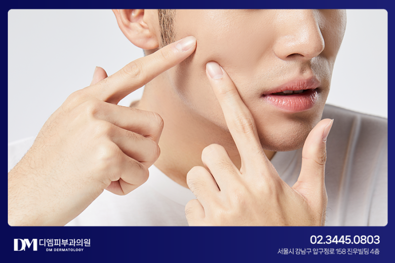 재발 쉬운 여드름, 흉터가 고민이라면?