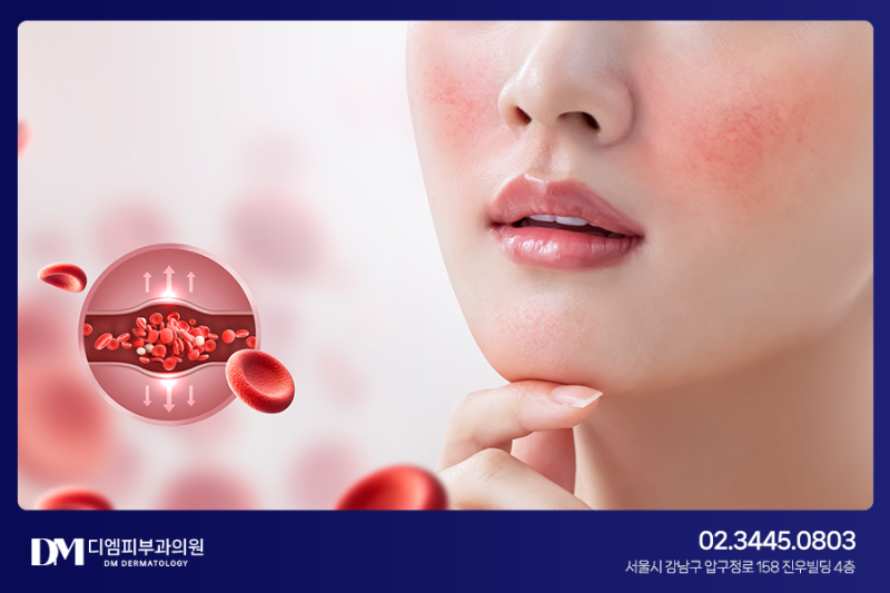 민망한 붉은 얼굴, 쿼드로스타 홍조레이저로 개선해요 사진 3
