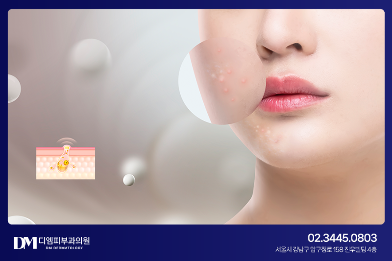 모공 속 노폐물을 제거하는 아쿠아필, 시술원리와 발생할 수 있는 부작용