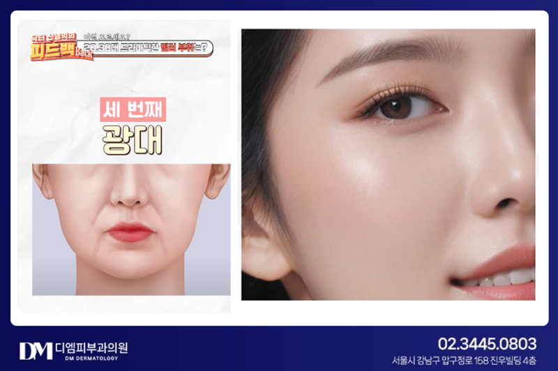 동안 얼굴 완성! 자연스럽게 예뻐지는 필러 추천 부위 TOP3 사진 5