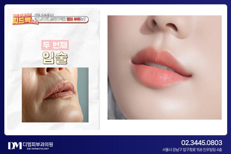 동안 얼굴 완성! 자연스럽게 예뻐지는 필러 추천 부위 TOP3 사진 4