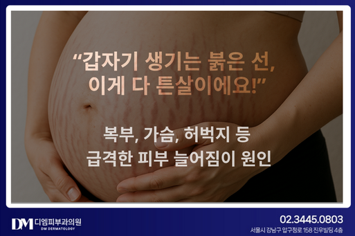임산부 튼살, 생기기 전에 막을 수 있을까? 생긴 후 임산부 튼살 치료까지 완벽 정리