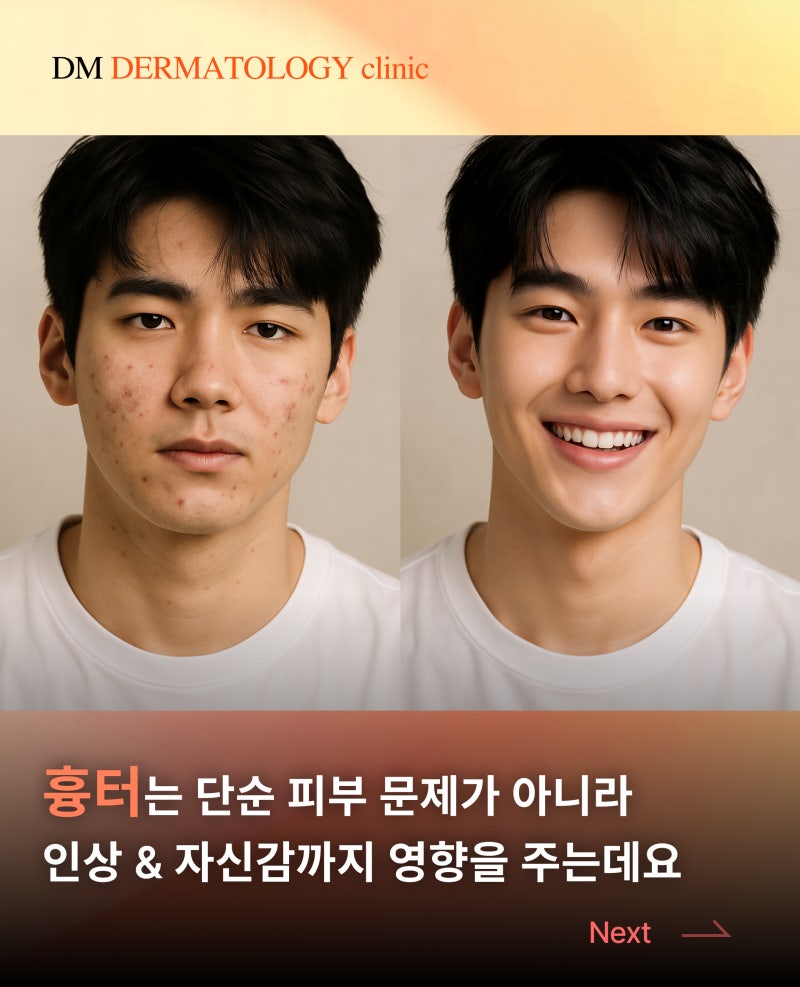 30대 남성 여드름 흉터 치료 1회 후기, 디엠피부과에서 알려드립니다. 사진 3