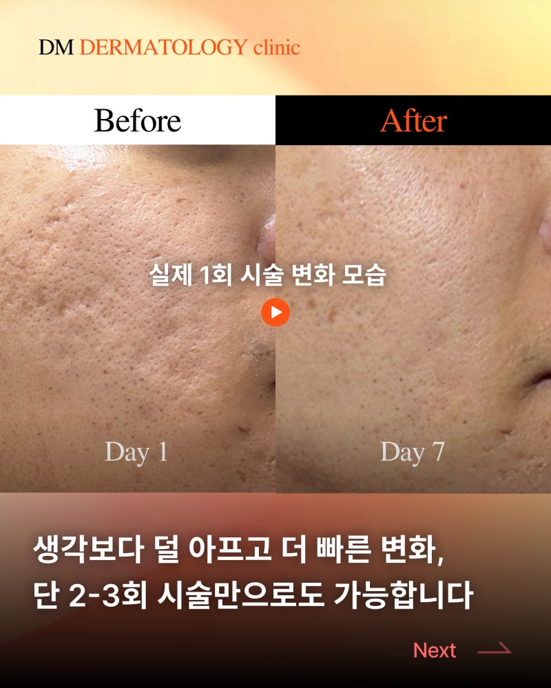 30대 남성 여드름 흉터 치료 1회 후기, 디엠피부과에서 알려드립니다. 사진 4