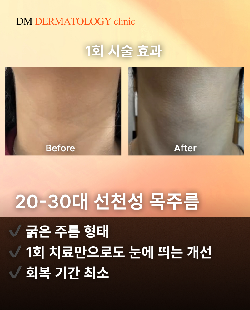 목주름 치료, 실제  목주름 시술 환자 후기와 피부과 전문의 꿀팁