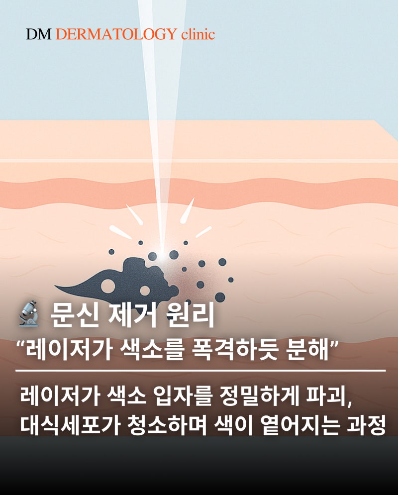 문신 제거 비용, 시간 총정리! 타투 지우기 전 꼭 알아야 할 3가지 핵심 포인트