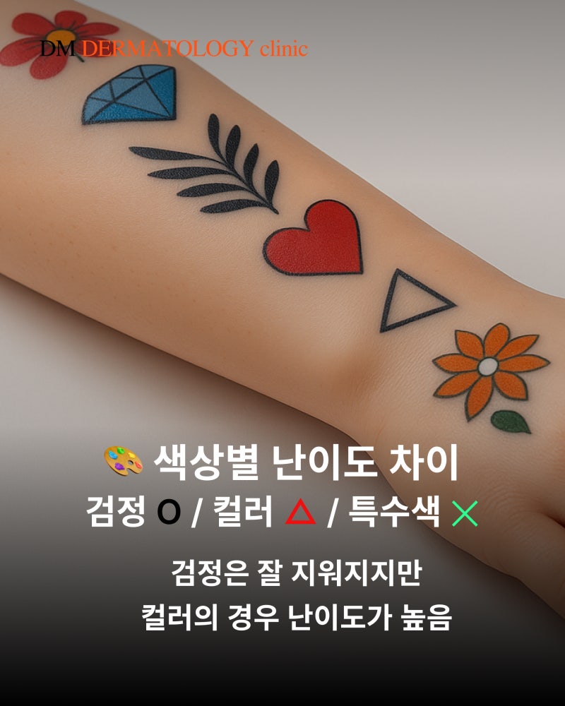 문신 제거 비용, 시간 총정리! 타투 지우기 전 꼭 알아야 할 3가지 핵심 포인트 사진 4