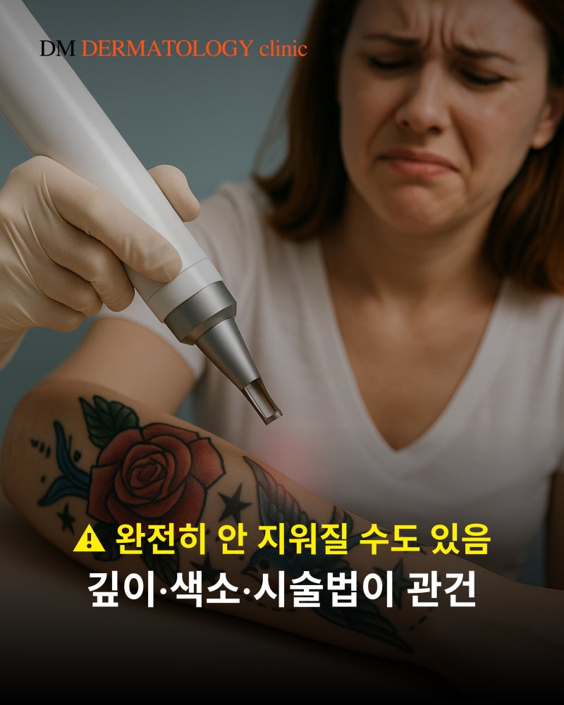 문신 제거 비용, 시간 총정리! 타투 지우기 전 꼭 알아야 할 3가지 핵심 포인트 사진 5