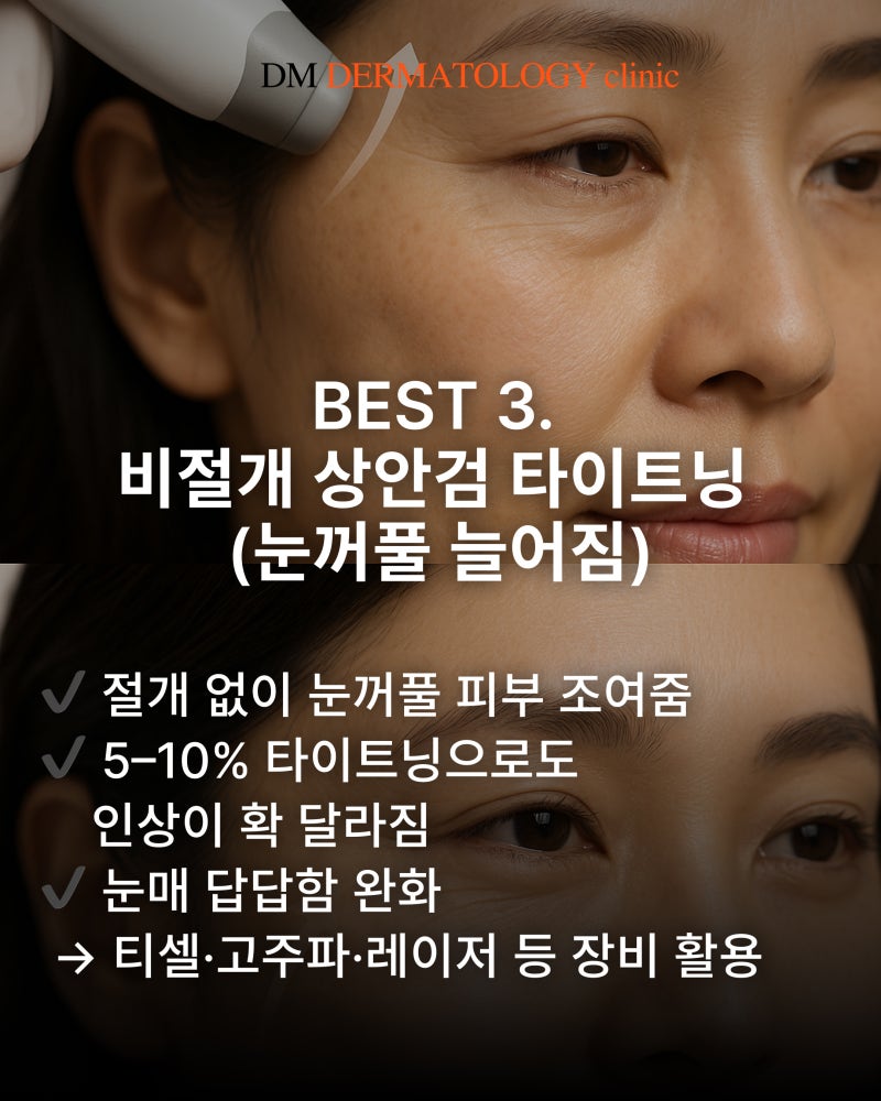 40·50대를 위한 동안 시술 BEST 5! 코필러부터 눈가 처짐, 실리프팅까지 사진 5